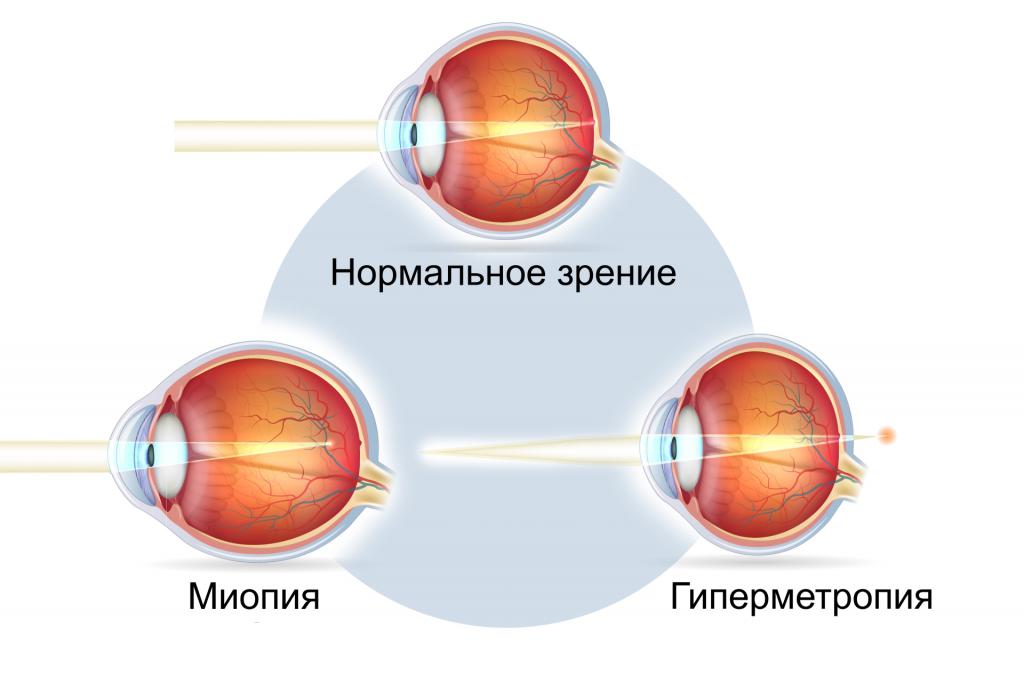 Близорукость глаза в физике thumbnail
