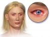 Заболевания кожи глаз у человека