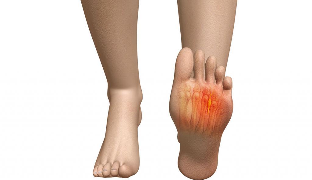 Почему болит подушечка ноги под пальцами лечение thumbnail