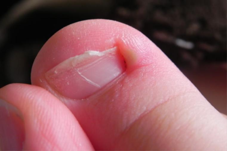 Почему болят ногти на большом пальце ноги thumbnail