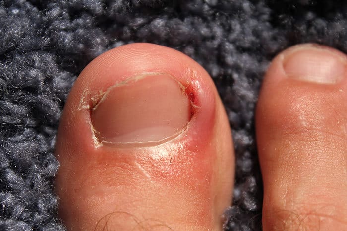 От чего может болеть большой палец на ноге под ногтем thumbnail