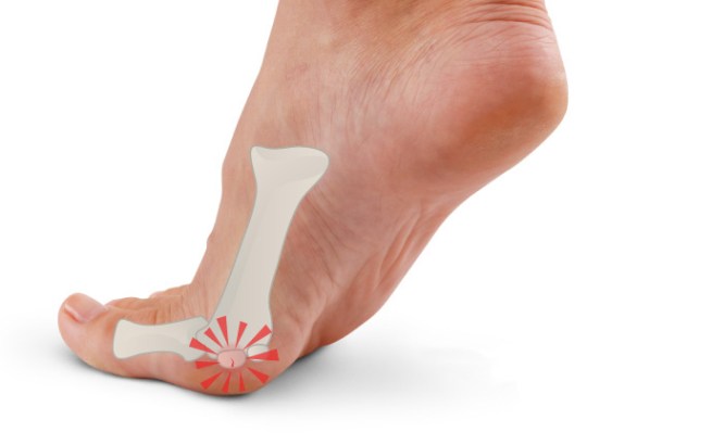 Что делать когда болят подушечки пальцы ног thumbnail