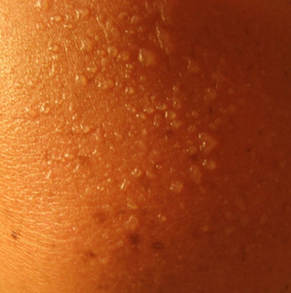 Солнечный дерматит лечение мазями thumbnail