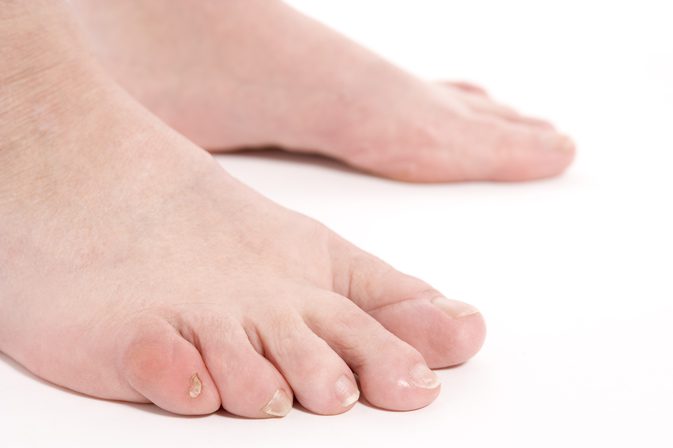 Как лечить ушиб мизинца на ноге: первая помощь и лечение thumbnail