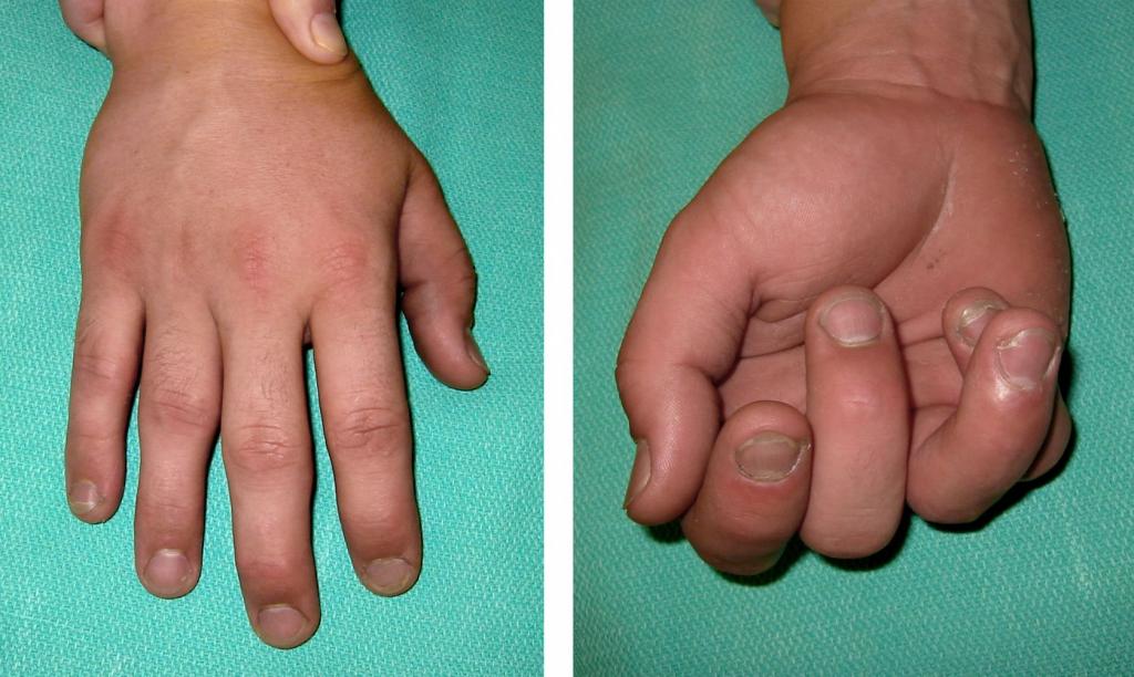 Перелом кисти руки со смещением лечение лфк массаж thumbnail