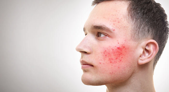 Воспаление кожи лица с высыпаниями thumbnail