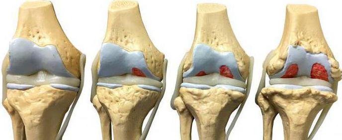 микрокристаллический артрит коленного сустава