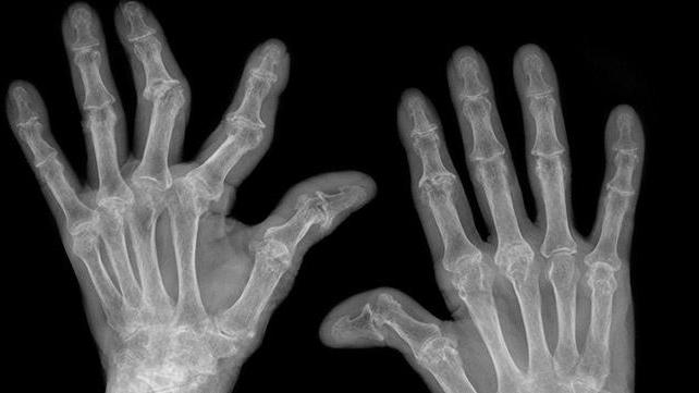 чем лечить артрит суставов пальцев рук
