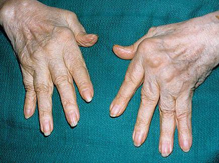 артрит рук лечение и симптомы