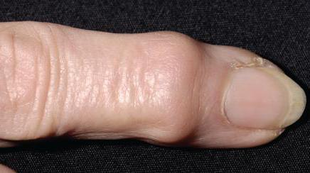 симптомы ревматоидного артрита кистей рук
