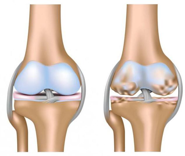 Чем артроз коленного сустава отличается от артрита