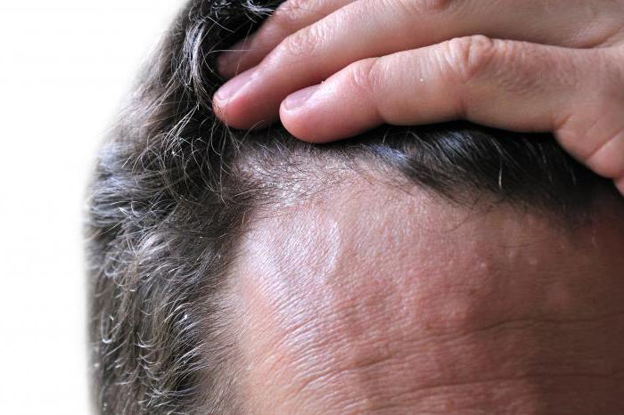 лечение себорейный дерматит волосистой части головы лечение