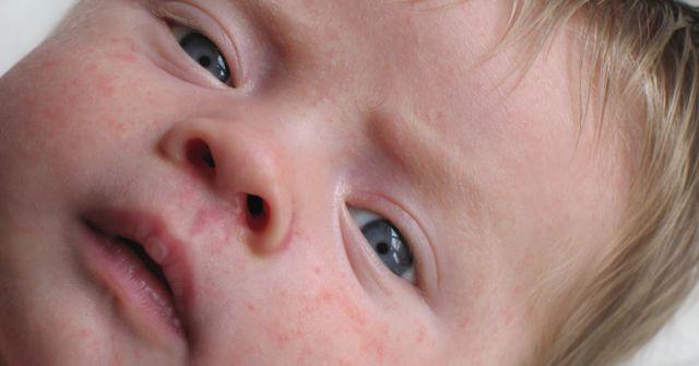 Заразен или нет дерматит у детей, передается ли по наследству атопический, периоральный, контактный вид