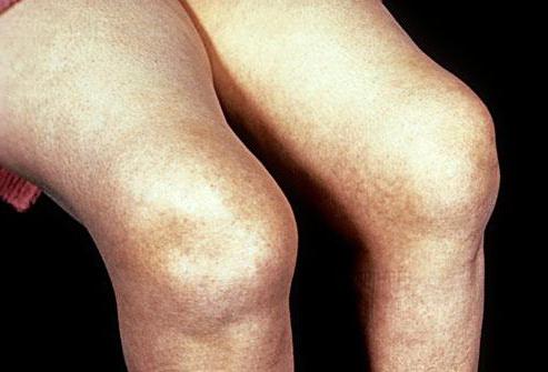лечение артрит коленного сустава симптомы и лечение