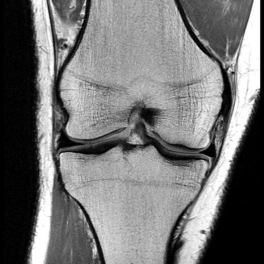 симптомы артрита коленного сустава