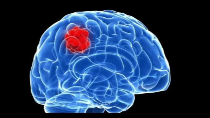 Гематома головного мозга симптомы