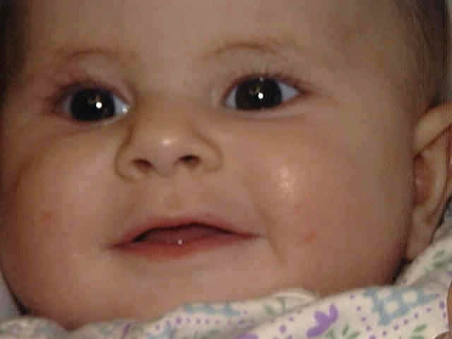  атопический дерматит у детей фото на лице 