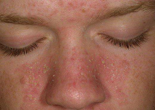 лечение аллергического дерматита на лице