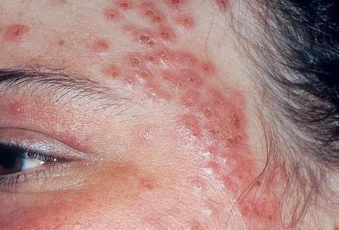 дерматит лечение на лице