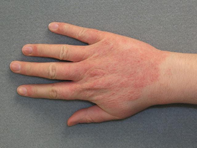 мазь от дерматита на руках 