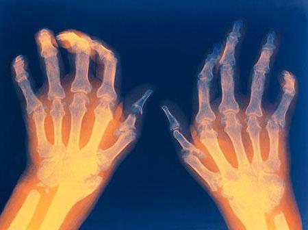 артрит на пальцах рук как лечить