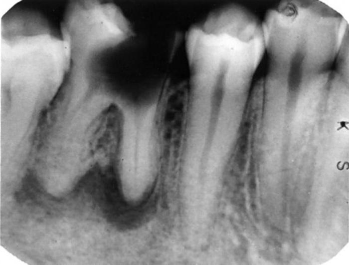 гранулема зуба симптомы