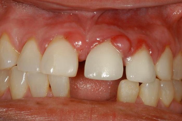 лечение зуба с гранулемой