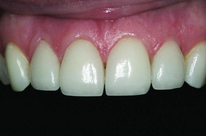 гранулемы зуба лечение народными средствами 