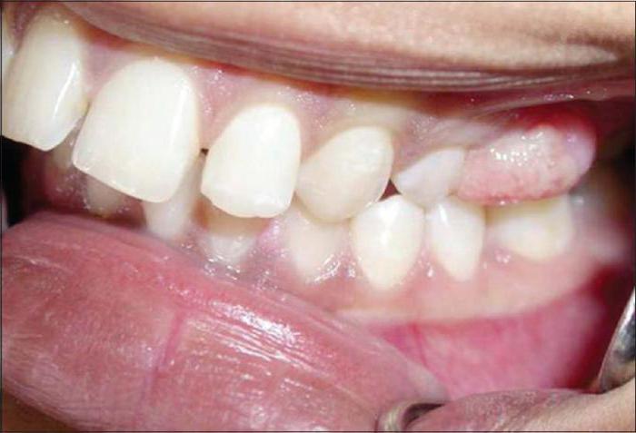гранулема зуба под коронкой лечение 