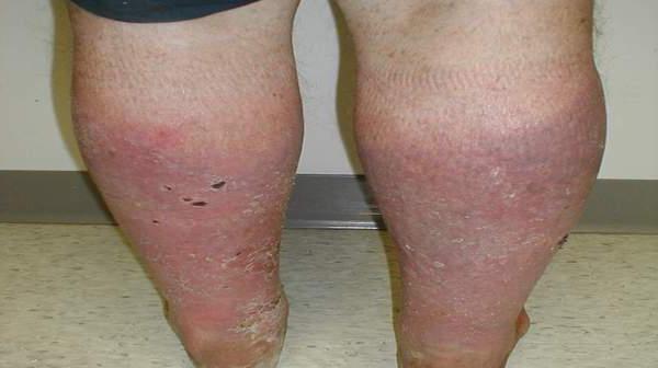 венозный дерматит на ногах лечение народными средствами