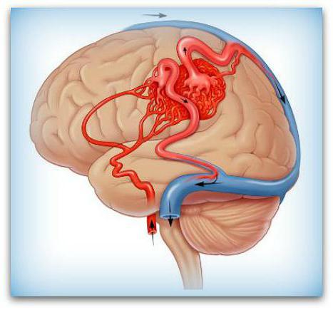 эпидуральная гематома головного мозга