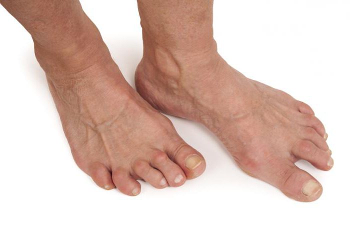 артрит пальцев стопы