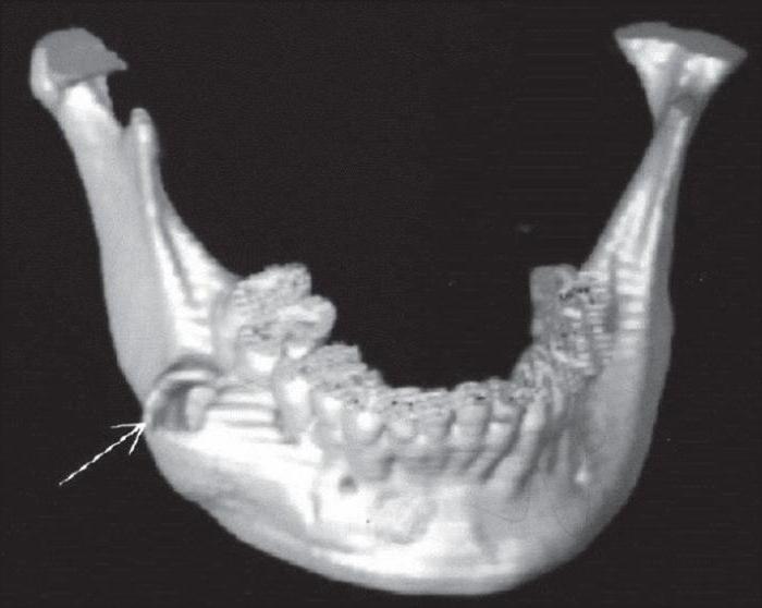 гранулема на корне зуба