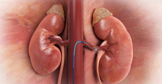 вазоренаьная и ренопаренхиматозная артериальная гипертензия