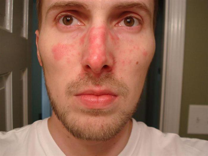 себорейный дерматит кожи лица 