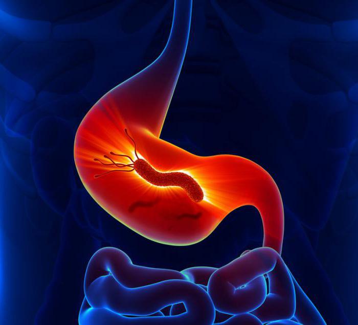 Гастрит с повышенной кислотностью: симптомы и лечение - Sammedic.ru