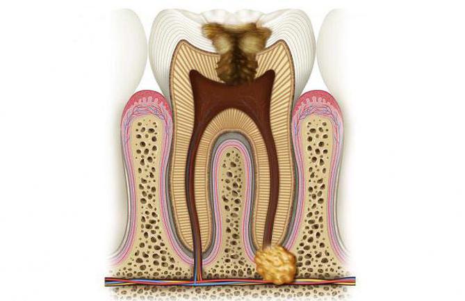 гранулема зуба лечение 