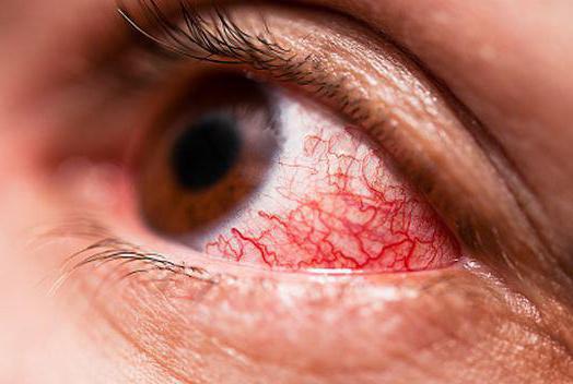 гипертоническая ангиопатия сетчатки обоих глаз