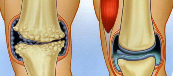 какие мази применять при артрозе коленного сустава
