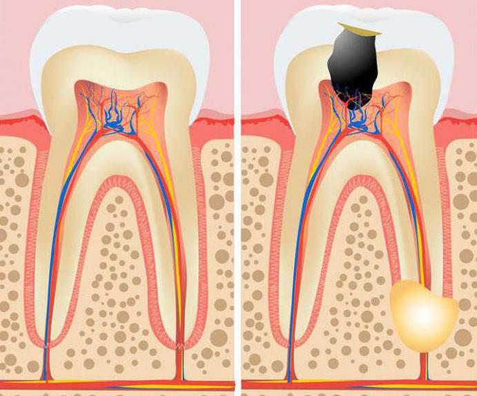 лечение гранулемы зуба отзывы