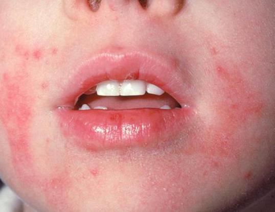 лечение народными средствами атопический дерматит у детей 