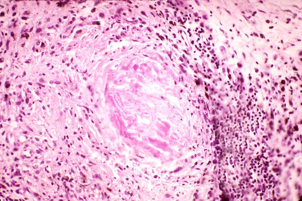фибриноидная дистрофия под микроскопом