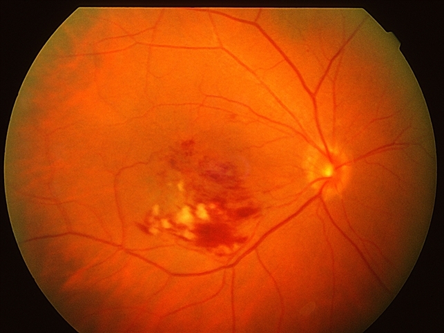 тромбоз сетчатки глаза лечение