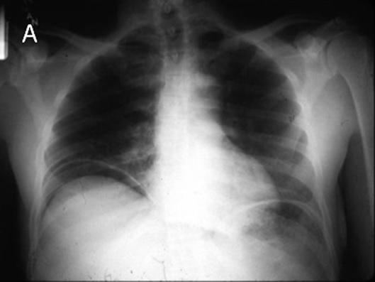 Рентген-картина экссудативного плеврита