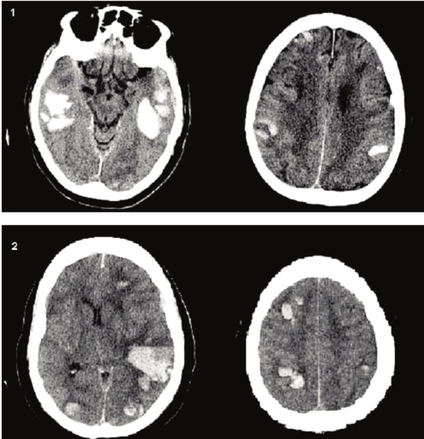 Нейролейкоз. Септические очаги головного мозга на кт. Нейролейкемия мрт. Кровоизлияние в головной мозг.