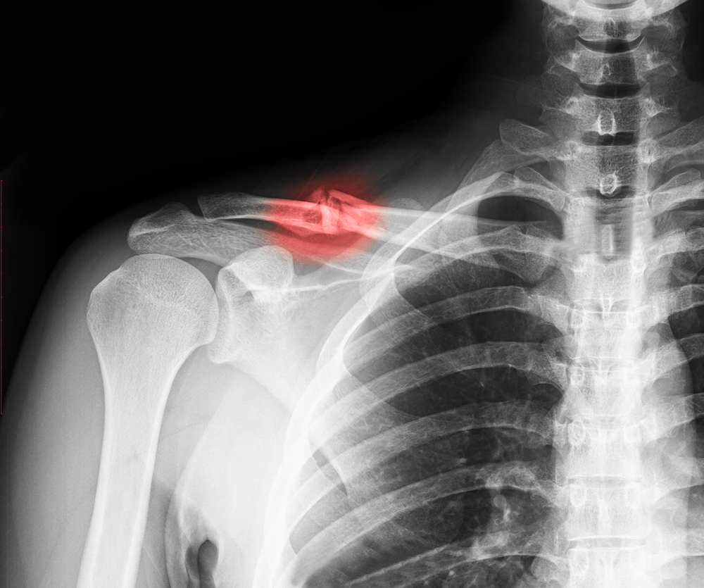 Перелом ключицы со смещением рентген