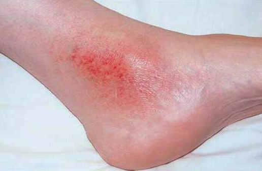 венозный дерматит на ногах мази