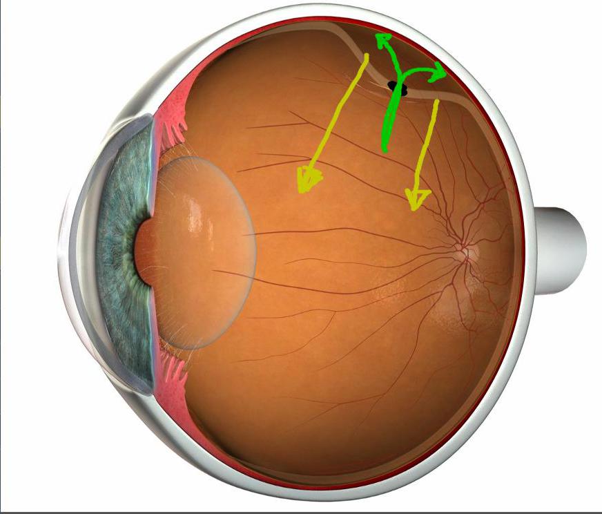 Замена сетчатки. Анатомия глаза отслойка сетчатки. Травматическое отслоение сетчатки. Сетчатка глаза строение отслоение. Клапанный разрыв сетчатки.