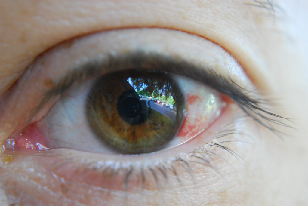 кровоизлияние в области глаза