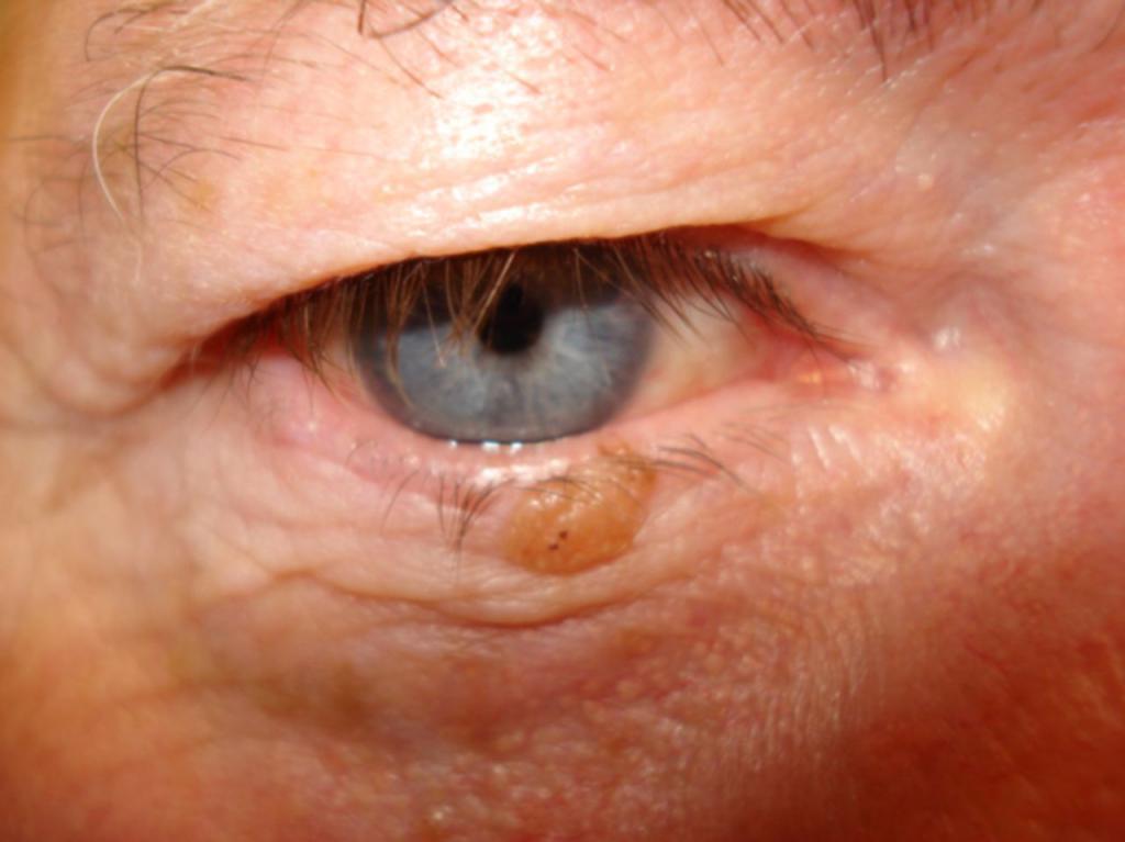 Лечение папилломы на глазу